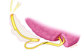 In an effort to preserve tongue movement, some have advocated splitting the hypoglossal nerve.