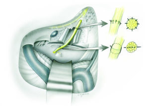 Translabyrinthine view of a facial nerve transection near its pontine root entry zone with the defect extending to past the entry of the fallopian canal, which has been drilled open. The distal anastomosis is performed with epineural 9–0 sutures. As the intracranial nerve lacks an epineurium, a single central suture reapproximates the ends, often reinforced with a wrapping of fascia or other membrane.