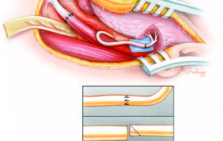 When a size mismatch is present, the smaller nerve is beveled to allow precise coaptation of the epineurial sheaths.